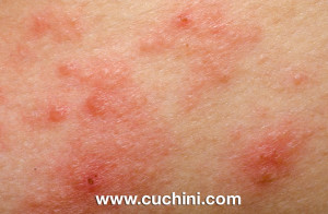 What is Eczema Symptoms