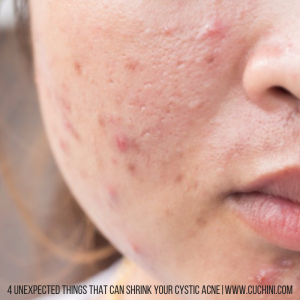 4 Unexpected Things That Can Shrink Your Cystic Acne